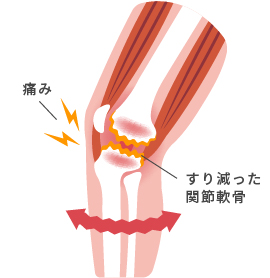 軟骨がすり減った膝